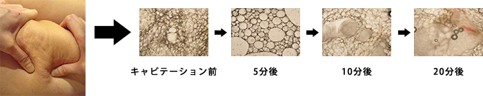 キャビフルのセルライトの改善効果